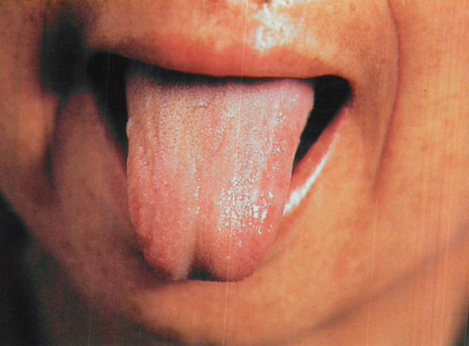 4. 4 舌与胃角、胃底粘膜像